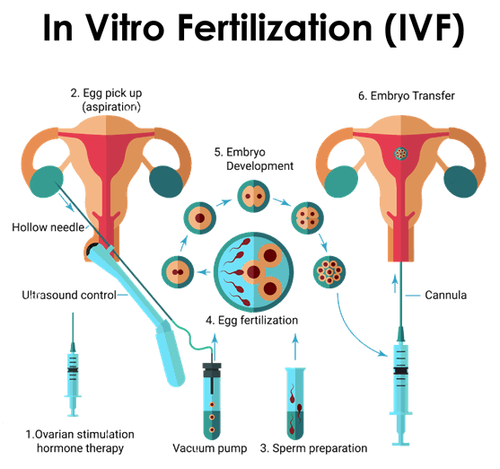 IVF treatment in Delhi